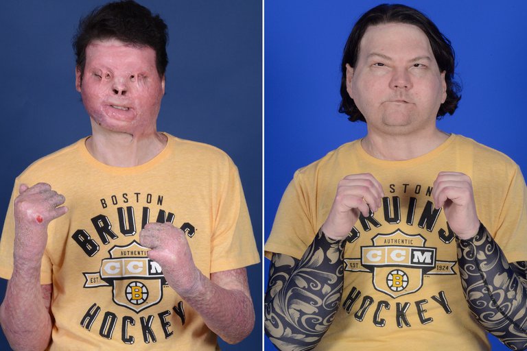antes y despues de la cirugia